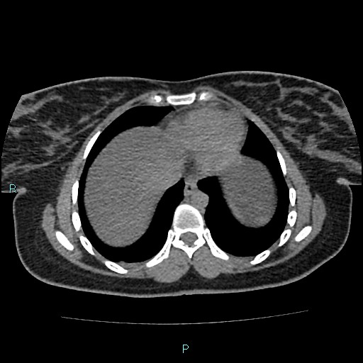 Acute bilateral pyelonephritis (Radiopaedia 37146-38881 Axial non-contrast 5).jpg