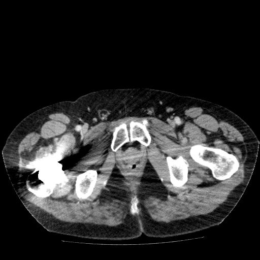 File:Acute cholecystitis and incidental left sided IVC (Radiopaedia 49352-54459 Axial C+ portal venous phase 158).jpg