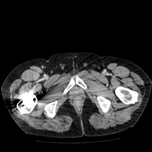 File:Acute cholecystitis and incidental left sided IVC (Radiopaedia 49352-54459 Axial C+ portal venous phase 164).jpg