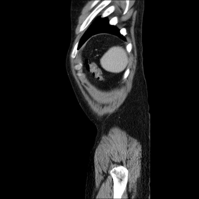 Acute cholecystitis and incidental left sided IVC (Radiopaedia 49352-54459 Sagittal C+ portal venous phase 12).jpg