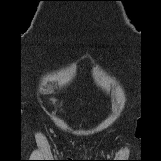 Acute cholecystitis and ureteric colic (Radiopaedia 42330-45444 Coronal prone 20).jpg