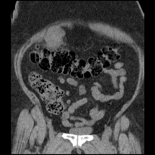 Acute cholecystitis and ureteric colic (Radiopaedia 42330-45444 Coronal prone 30).jpg