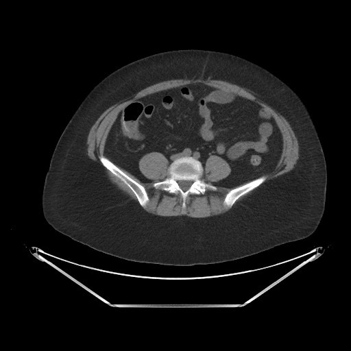 Acute cholecystitis with tensile fundus sign (Radiopaedia 71394-81723 Axial non-contrast 71).jpg