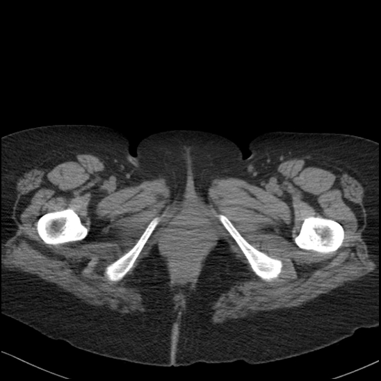 Acute colonic hemorrhage in ulcerative colitis (Radiopaedia 77415-89538 Axial non-contrast 147).jpg