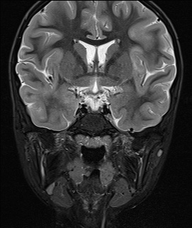 File:Acute disseminating encephalomyelitis with bilateral optic neuritis (Radiopaedia 79676-92886 Coronal STIR 17).jpg