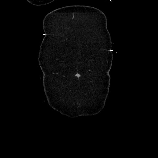 Acute diverticulitis - transverse colon (Radiopaedia 87063-103327 Coronal C+ portal venous phase 23).jpg