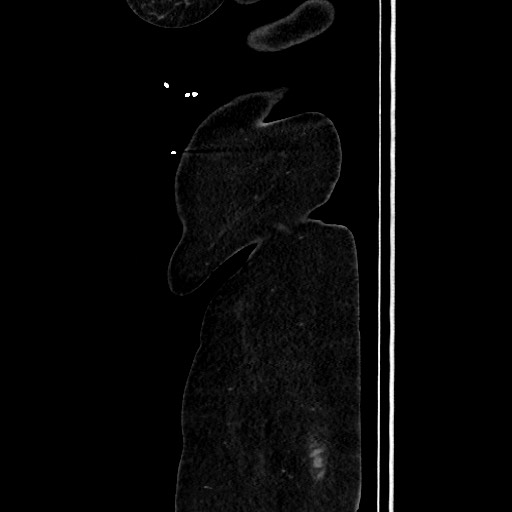 Acute diverticulitis - transverse colon (Radiopaedia 87063-103327 Sagittal C+ portal venous phase 215).jpg