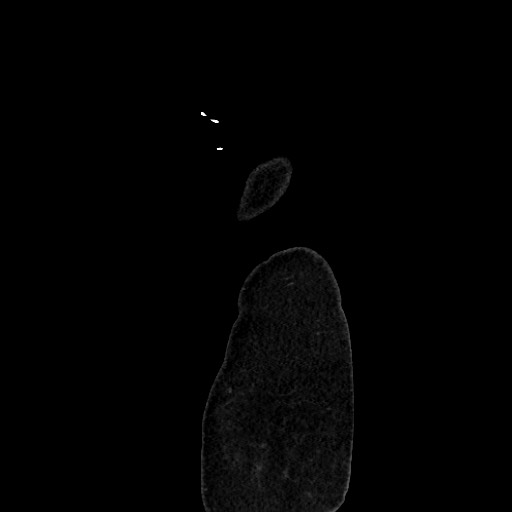 Acute diverticulitis - transverse colon (Radiopaedia 87063-103327 Sagittal C+ portal venous phase 232).jpg