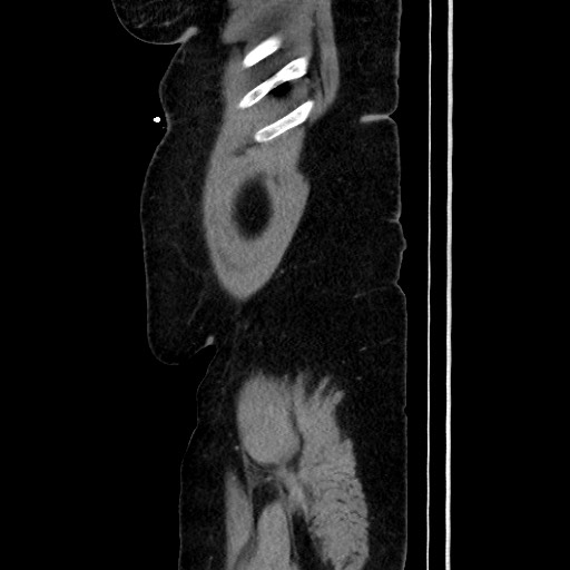 Acute diverticulitis - transverse colon (Radiopaedia 87063-103327 Sagittal C+ portal venous phase 46).jpg
