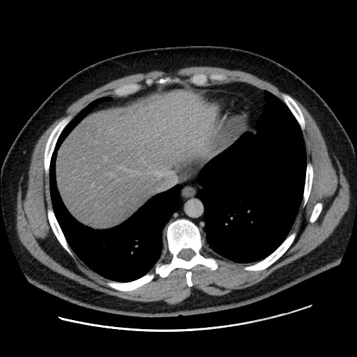 File:Acute diverticulitis with localized perforation (Radiopaedia 41296-44113 Axial C+ portal venous phase 11).jpg