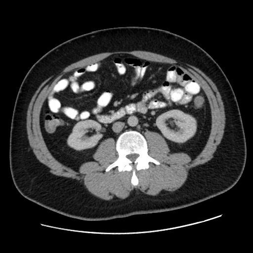Acute diverticulitis with localized perforation (Radiopaedia 41296-44113 Axial C+ portal venous phase 45).jpg