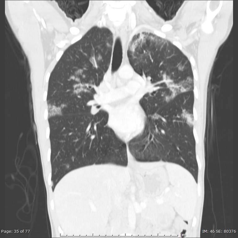 Acute eosinophilic pneumonia (Radiopaedia 48211-53073 Coronal lung window 23).jpg