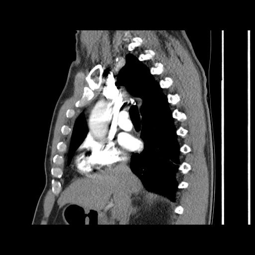 Acute epicardial fat necrosis (Radiopaedia 42327-45440 Sagittal C+ CTPA 32).jpg