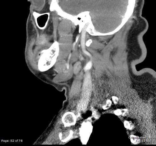 Acute epiglottitis (Radiopaedia 54375-60590 Sagittal C+ arterial phase 52).jpg