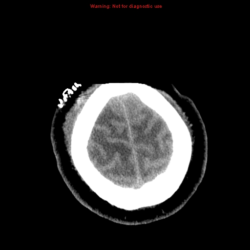 File:Acute hemorrhagic leukoencephalitis (Radiopaedia 14076-72275 Axial non-contrast 42).jpg