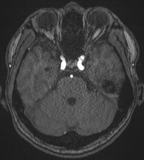Acute left middle cerebral artery territory infarct with clot retrieval (Radiopaedia 47732-52433 Axial MRA 19).png