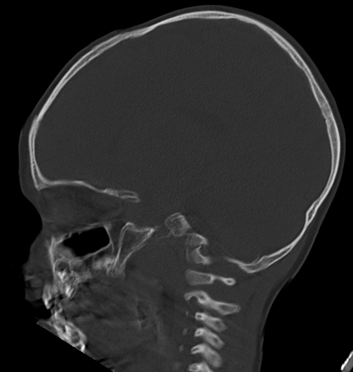 Acute mastoiditis (Radiopaedia 82678-96881 Sagittal bone window 26).jpg