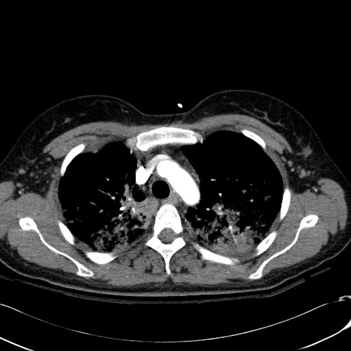 File:Acute myocardial infarction in CT (Radiopaedia 39947-42415 Axial C+ arterial phase 35).jpg