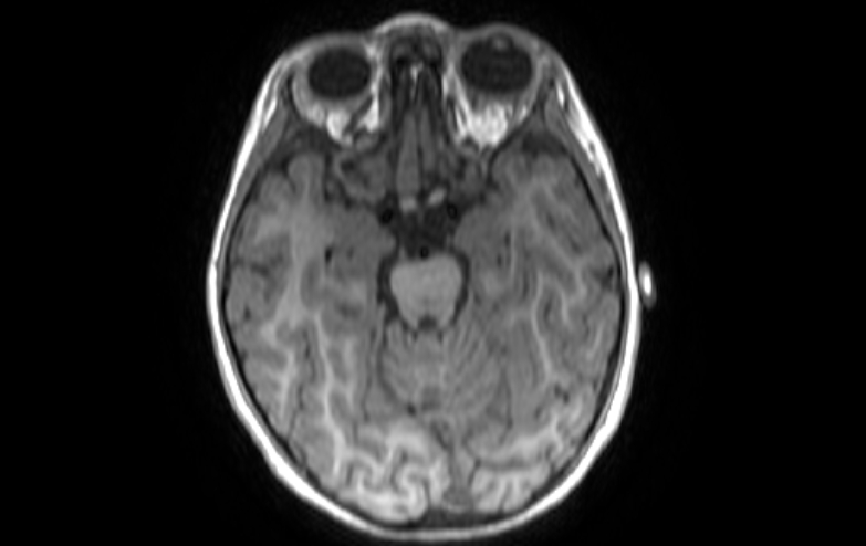 File:Acute necrotizing encephalitis of childhood (Radiopaedia 67356-76737 Axial T1 63).jpg