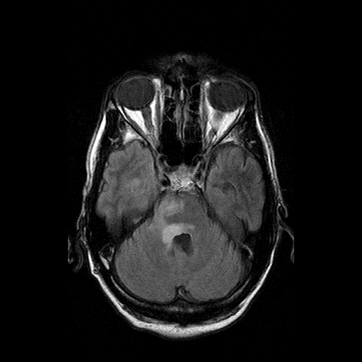 File:Acute necrotizing toxoplasma encephalitis (Radiopaedia 10683-11149 Axial FLAIR 13).jpg