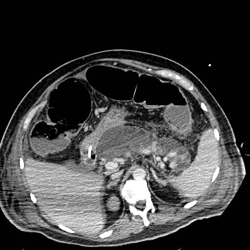 Acute pancreatic necrosis (Radiopaedia 13560-18501 Axial C+ portal venous phase 40).jpg