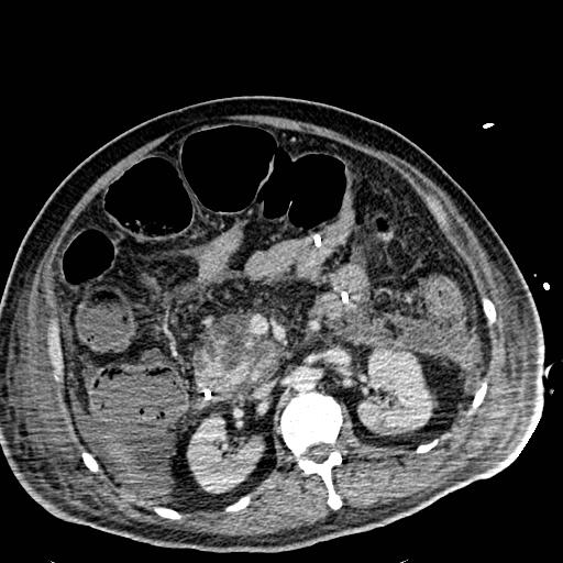 Acute pancreatic necrosis (Radiopaedia 13560-18501 Axial C+ portal venous phase 57).jpg