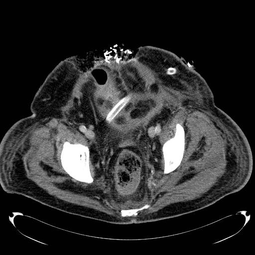 Acute pancreatic necrosis (Radiopaedia 13560-18503 Axial C+ portal venous phase 73).jpg