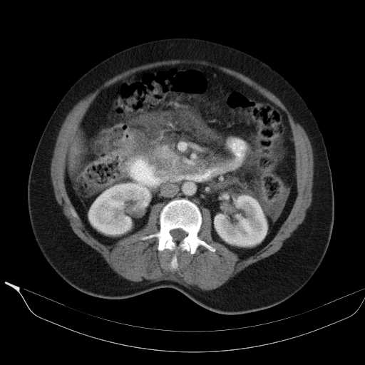 File:Acute pancreatitis (Radiopaedia 20829-20744 Axial C+ portal venous phase 22).jpg