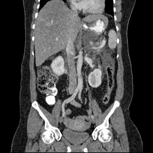 File:Acute pancreatitis (Radiopaedia 20829-20744 Coronal C+ portal venous phase 30).jpg