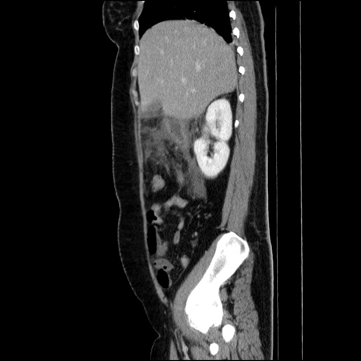 Acute pancreatitis (Radiopaedia 69236-79012 Sagittal C+ portal venous phase 70).jpg