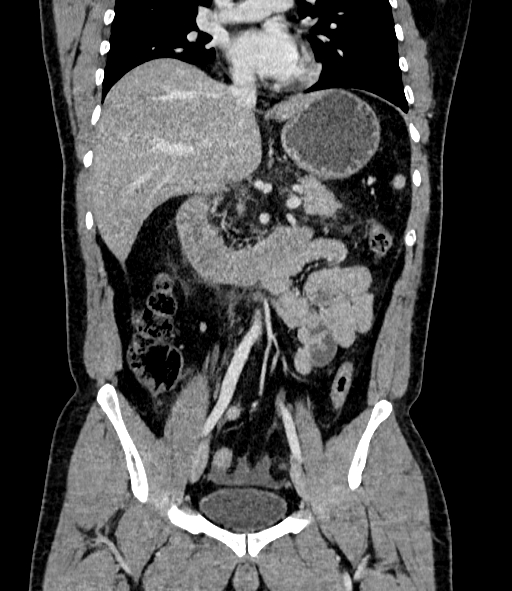 Acute pancreatitis (Radiopaedia 87428-103757 Coronal C+ portal venous phase 46).jpg