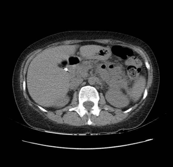 File:Acute pancreatitis - Balthazar E - post ERCP (Radiopaedia 27562-27772 Axial non-contrast 20).png