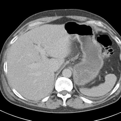 Acute pancreatitis and walled-off necrosis (Radiopaedia 29888-30403 Axial C+ delayed 19).jpg