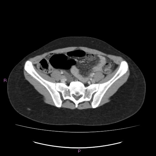 File:Acute pancreatitis secondary to stone at minor papilla and pancreatic divisum (Radiopaedia 76570-88333 Axial C+ portal venous phase 58).jpg