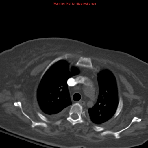Acute pulmonary embolism (Radiopaedia 13286-13289 Axial C+ CTPA 17).jpg