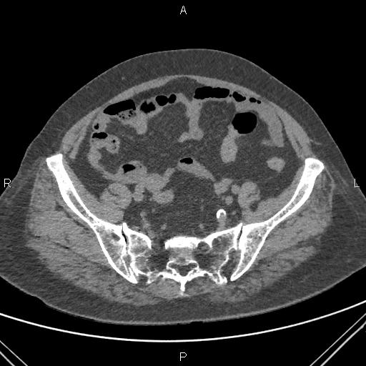 Acute renal artery occlusion (Radiopaedia 86586-102682 Axial non-contrast 71).jpg