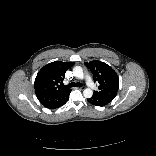 Acute segmental pulmonary emboli and pulmonary infarction (Radiopaedia 62264-70444 Axial C+ CTPA 43).jpg