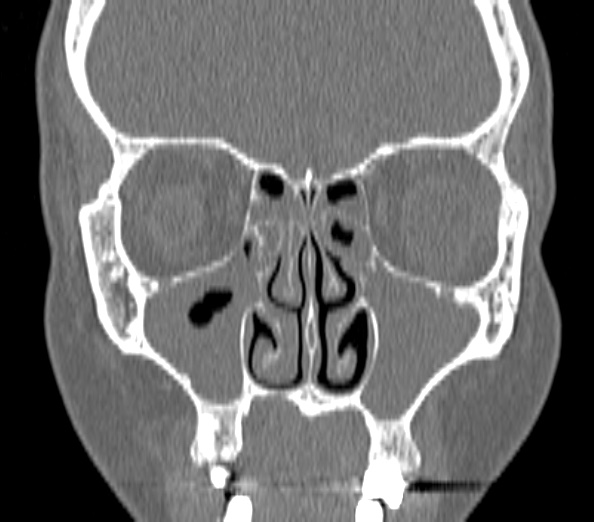 File:Acute sinusitis (Radiopaedia 40564-43158 Coronal bone window 16).jpg