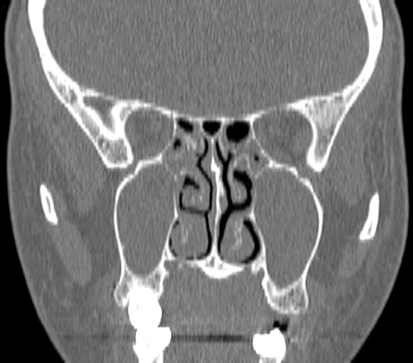 File:Acute sinusitis (Radiopaedia 40564-43158 Coronal bone window 25).jpg