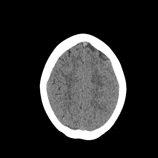 Acute subarachnoid hemorrhage and accessory anterior cerebral artery (Radiopaedia 69231-79008 Axial non-contrast 41).jpg