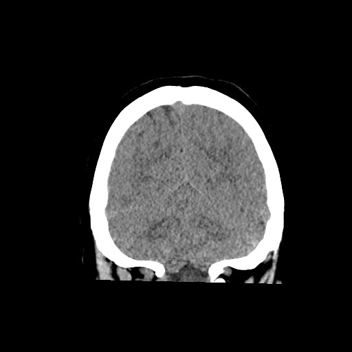 Acute subarachnoid hemorrhage and accessory anterior cerebral artery (Radiopaedia 69231-79008 Coronal non-contrast 56).jpg