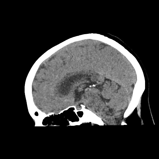 Acute subarachnoid hemorrhage and accessory anterior cerebral artery (Radiopaedia 69231-79008 Sagittal non-contrast 30).jpg