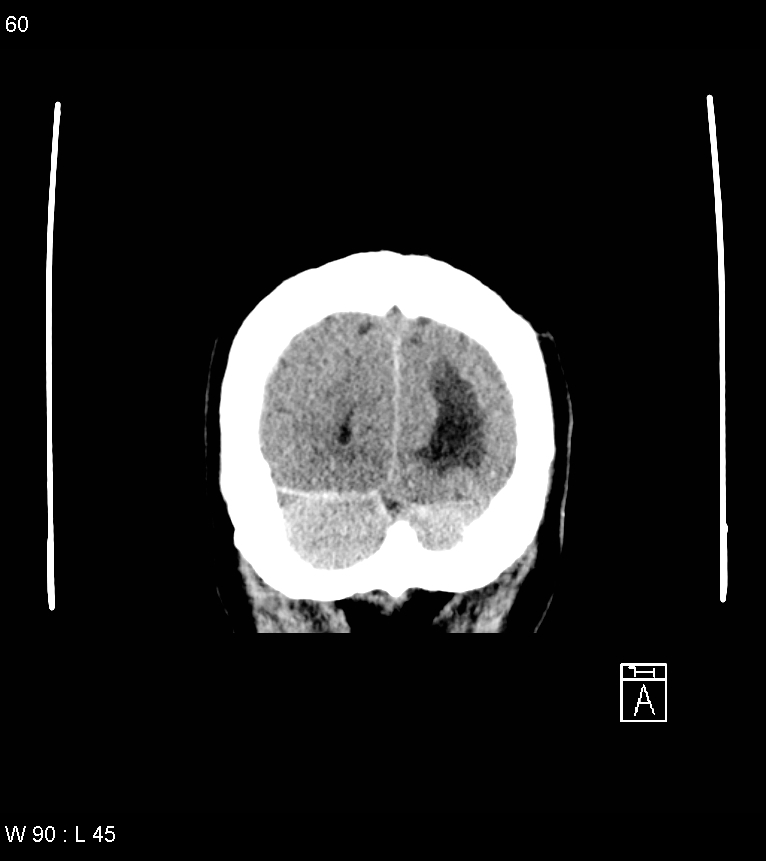 Acute subdural hematoma with myelofibrosis (Radiopaedia 52582-58494 Coronal non-contrast 51).jpg