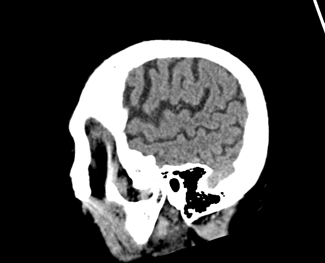 Acute traumatic subdural hematoma (Radiopaedia 82921-97257 Sagittal non-contrast 59).jpg