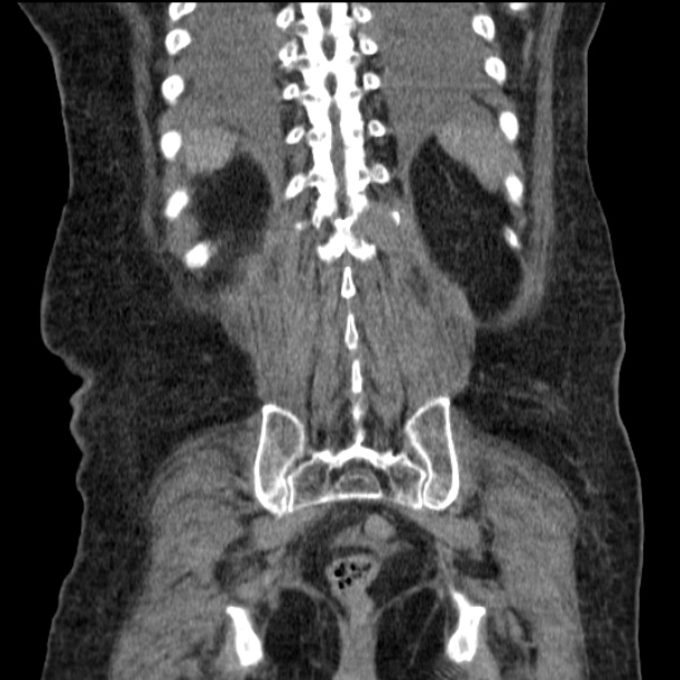 Acute tubular necrosis (Radiopaedia 28077-28334 G 68).jpg