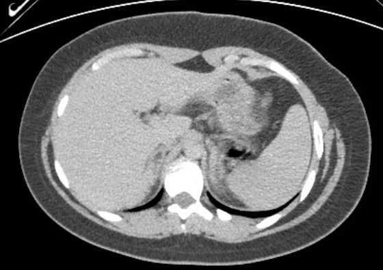 Acute unilateral nonhemorrhagic adrenal infarction (Radiopaedia 67560-76957 Axial renal excretory phase 18).jpg