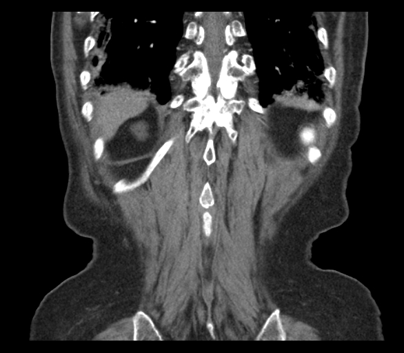 Adenocarcinoma of cecum (Radiopaedia 59222-66549 Coronal C+ arterial phase 65).jpg