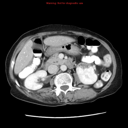 File:Adenocarcinoma of the colon (Radiopaedia 8191-9039 Axial liver window 31).jpg