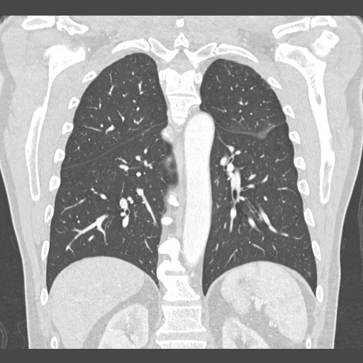 Adenocarcinoma of the lung (Radiopaedia 59871-67325 Coronal lung window 42).jpg
