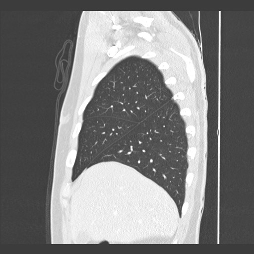 Adenocarcinoma of the lung (Radiopaedia 59871-67325 Sagittal lung window 17).jpg